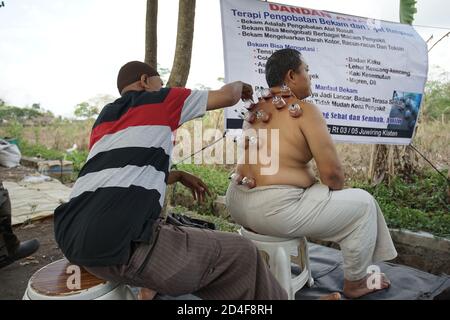 Yogyakarta, Indonesien - 31. Oktober 2018: Ein Mann nahm sein Blut mit traditioneller Schröpfmethode namens bekam auf dem Jangkang traditionellen Markt Stockfoto