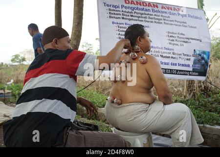 Yogyakarta, Indonesien - 31. Oktober 2018: Ein Mann nahm sein Blut mit traditioneller Schröpfmethode namens bekam auf dem Jangkang traditionellen Markt Stockfoto