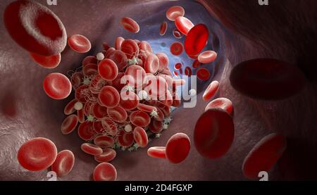 Darstellung von einem Blutgerinnsel bilden in ein Blutgefäß. 3D-Darstellung Stockfoto