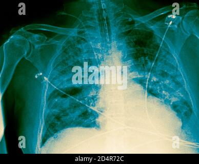 Lungen, die vom Covid-19 Coronavirus betroffen sind, Röntgen. Stockfoto