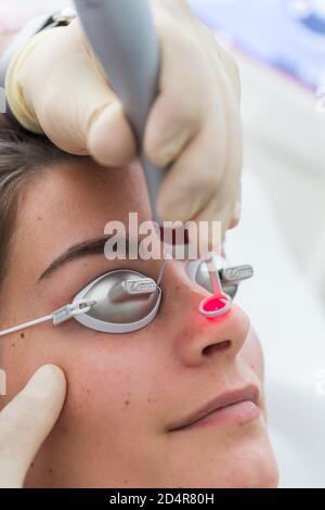 Vaskuläre Laser für die Behandlung von Rosacea und Varizen. Stockfoto