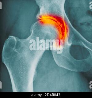 Röntgen zeigt Arthritis der Hüfte, Arthritis ist eine Gelenkerkrankung, die Knorpelzerstörung, Knochenerodieren und Sehnenentzündung verursachen kann. Stockfoto