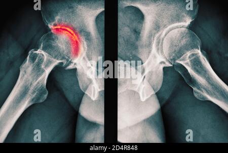 Röntgen zeigt Arthritis der Hüfte, Arthritis ist eine Gelenkerkrankung, die Knorpelzerstörung, Knochenerodieren und Sehnenentzündung verursachen kann. Stockfoto