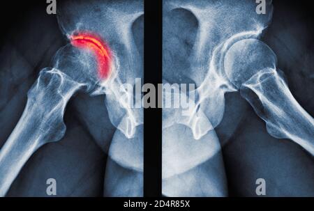 Röntgen zeigt Arthritis der Hüfte, Arthritis ist eine Gelenkerkrankung, die Knorpelzerstörung, Knochenerodieren und Sehnenentzündung verursachen kann. Stockfoto