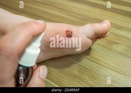 Brennen Sie auf dem Fuß eines Kindes. Die Verbrennungen Blister platzen, Wundheilung. Behandlung der Wunde mit Wasserstoffperoxid. Du kannst den Fuß des Kindes sehen; die Hand Stockfoto