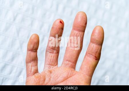 Schwerer ekzematöser Ausschlag an den Händen einer Frau. Stockfoto