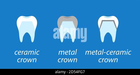 Symbole Dental auf blauem Hintergrund. Service Installation einer keramischen Krone. Sowie eine Krone aus Metall und Gold auf dem Zahn. Symbole flacher Stil festlegen. Stock Vektor