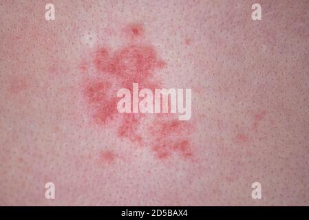 Menschliche Haut mit roten allergischen Flecken, Wunden Stockfoto