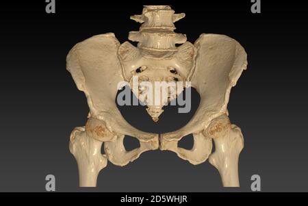 CT-Scan des Beckenknochens mit 3D-Rendering-Bild beider Hüftgelenke auf schwarzem Hintergrund. Beschneidungspfad. Stockfoto