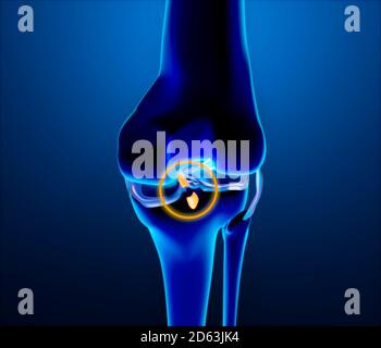 Gebrochenes hinteres Kreuzband. Verletzung und Bruch. Vergrößerung der Knochen von Knie, Oberschenkel und Tibia. Anatomie. 3d-Rendering Stockfoto