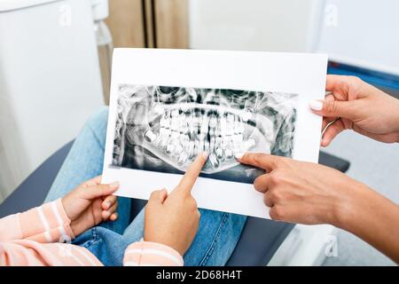 Röntgenaufnahme von Kinderzähnen. Milch und Molaren sind im Bild zu sehen, Nahaufnahme Stockfoto