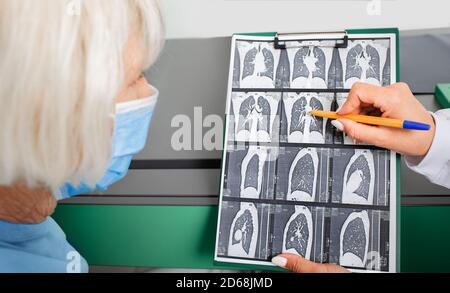 Ältere Patienten, CT der Lunge. Lungenentzündung, Bronchitis, Coronavirus, COVID 19 Stockfoto