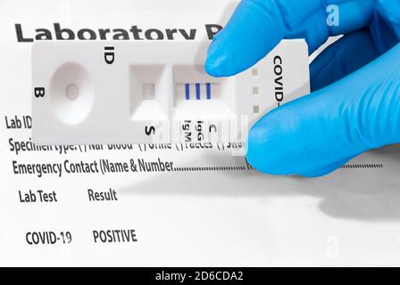 Die Hand eines Arztes oder eines Laboranten zeigt einen schnellen COVID-19-Labortest zum Nachweis von IgM- und IgG-Antikörpern gegen das neue Coronavirus SARS-CoV-2 wit Stockfoto