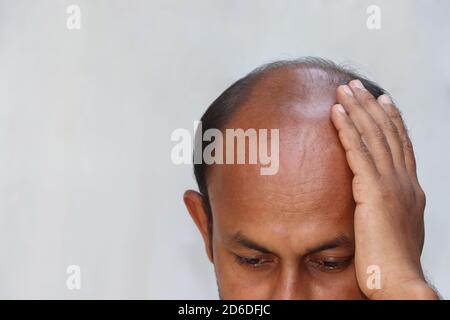 Halb kahlköpfiger asiatischer Mann verärgert über weiteren Haarausfall Problem isoliert auf dem weißen Hintergrund des Kopierbereichs Stockfoto