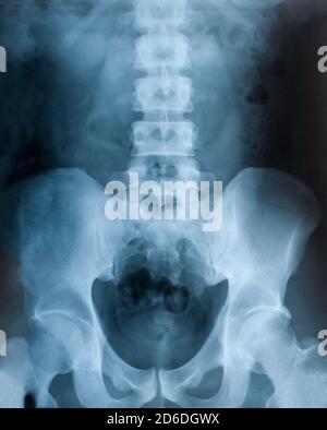 Röntgenfilm des Beckens, Gesundheitsuntersuchung Stockfoto