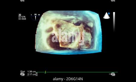 3D-Bild des Herzens während des transösophagealen Ultraschalls. Stockfoto