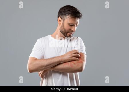Verärgerter Mann kratzt Juckreiz auf seinem Arm Stockfoto
