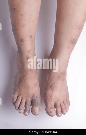 Nahaufnahme der Beine einer Frau mit chronischer Psoriasis auf weißem Hintergrund. Nahaufnahme von Hautausschlag und Schuppenbildung auf der Haut des Patienten. Dermatologisch Stockfoto