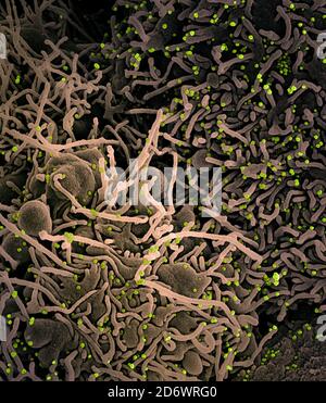 Koloriertes Rasterelektronenmikrograph einer VERO E6-Zelle (tan) mit länglichen Zellprojektionen und Anzeichen einer Apoptose nach einer SARS-Infektion Stockfoto