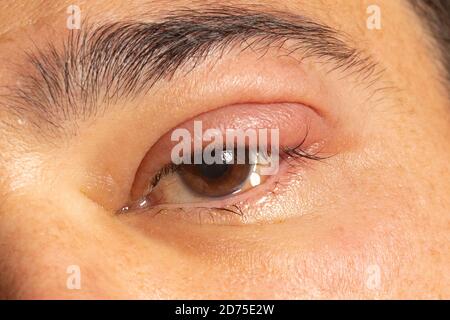 Entzündetes Auge mit infiziertem Stier, Oberlid, Augenheilkunde. Stockfoto