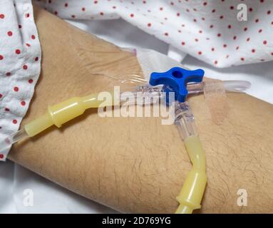 Nahaufnahme des Gefäßkatheters im Arm des Patienten Stockfoto