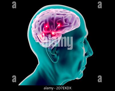Seitenansicht des Gehirns eines älteren Mannes. Neuronen und Synapsen. Parkinson, Alzheimer. Neuronale Netzschaltung, degenerative Erkrankungen Stockfoto