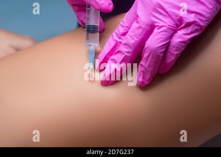 Entfernung von Keloid-Narben. Die Kosmetikerin gibt eine Injektion, um die Haut zu erneuern. Stockfoto