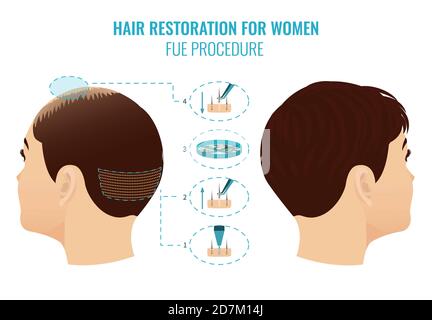 Illustration der Behandlung von weiblichem Haarausfall mit follikulärer Einheitenextraktion (FuE). Stufen des FuE-Verfahrens für Frauen. Stockfoto