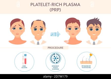 Thrombozytenreiches Plasma (PRP) Behandlung, konzeptionelle Illustration. Stockfoto