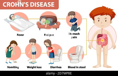 Medizinische Infografik zur Illustration der Morbus Crohn Stock Vektor