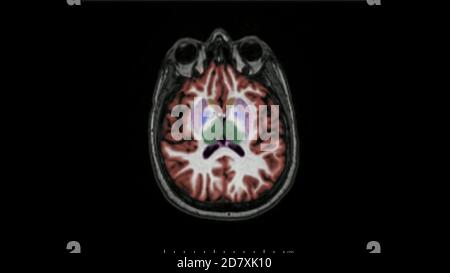 Magnetresonanztomographie des Gehirns in axialer Ebene farbcodierte Sequenz für die Diagnose von Gedächtnisstörungen und Alzheimer-Krankheit verwendet. MRT-Gehirn. Stockfoto
