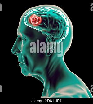 Seitenansicht des Gehirns eines älteren Mannes. Tumor. Neuronen und Synapsen. Degenerative Erkrankungen, Parkinson, Alzheimer. 3d-Rendering Stockfoto
