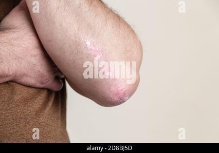 Schuppenflechte am Ellenbogen. Closeup Dermatitis auf der Haut krank allergischer Ausschlag Dermatitis Ekzem des Patienten atopische Dermatitis Symptom Haut Detail Textur, Fungu Stockfoto