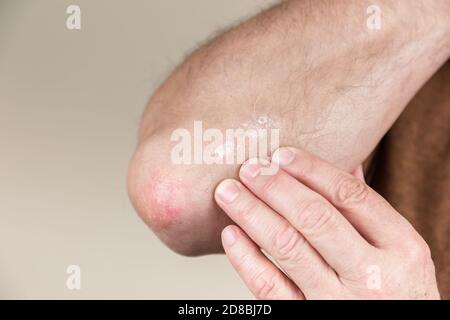 Schuppenflechte am Ellenbogen. Closeup Dermatitis auf der Haut krank allergischer Ausschlag Dermatitis Ekzem des Patienten atopische Dermatitis Symptom Haut Detail Textur, Fungu Stockfoto