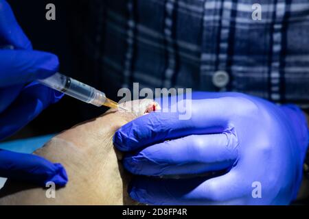 Serie der eingewachsenen Zehennagelbehandlung. Arzt injiziert Lokalanästhesie in den Zeh Stockfoto