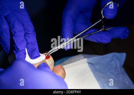 Serie der eingewachsenen Zehennagelbehandlung. Arzt schneiden und extrahieren Zehennagel-Infektion mit forcep Schere Stockfoto