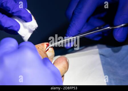 Serie der eingewachsenen Zehennagelbehandlung. Arzt schneiden und extrahieren Zehennagel-Infektion mit forcep Schere Stockfoto