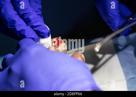 Serie der eingewachsenen Zehennagelbehandlung. Arzt schneiden und extrahieren Zehennagel-Infektion mit forcep Schere Stockfoto