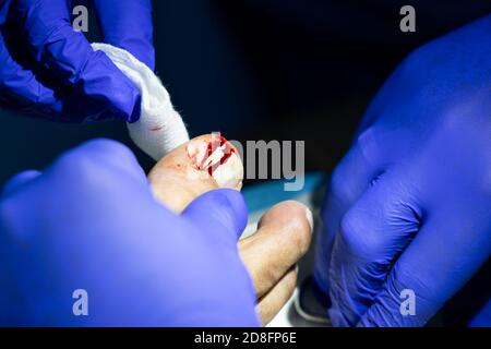 Serie der eingewachsenen Zehennagelbehandlung. Infizierten Teil der Zehennagel entfernt. Stockfoto