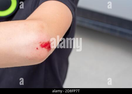 Selektiver Fokus einer frischen Wunde am Arm, Ellenbogen mit Blut. Gesundheitsmedizinisches Konzept. Speicherplatz kopieren Stockfoto