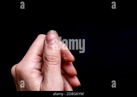 Nahaufnahme eines weiblichen Daumens mit einer weichen Fossa auf einem Nagel, einer überwucherten Nagelhaut, einer schälenden Nagelschicht, schlechter Maniküre Stockfoto