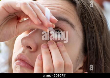 Nahaufnahme eines jungen Mädchens, das mit roten Gefäßen auf ihr Auge tropft, um ihr Sehvermögen zu verbessern. Reizung und Rötung des Augapfels Stockfoto