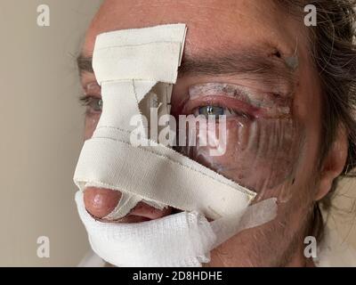 ace nach Nasenscheidekorrektur Operation und Facelift. Echtes Foto. Stockfoto