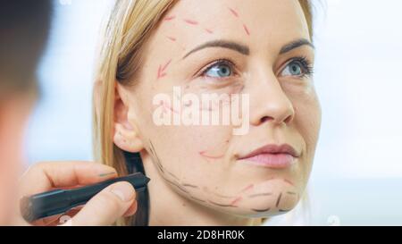 Nahaufnahme des schönen weiblichen Gesichts und plastischen kosmetischen Chirurgen zeichnen Linien mit Markt für zukünftige Facelift Operation. Stockfoto