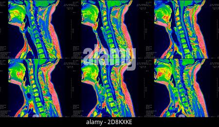 Satz von 6 sagittalen, grün gefärbten MRT-Aufnahmen des Halses Bereich von kaukasischen 34 Jahre alten Männchen mit beidseitigen paramedialen Extrusion des C6-C7-Segments Stockfoto