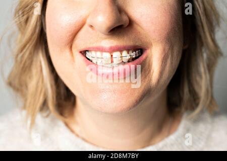 Zahnspange Zähne Mund Kieferorthopädie Frau in der Nähe Stockfoto