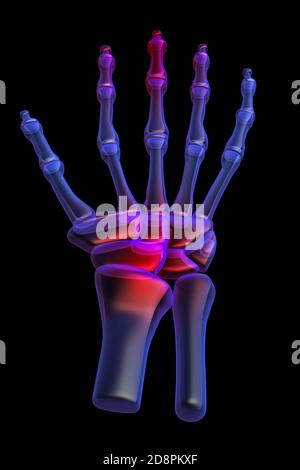 3d menschliche Handschmerzen Stockfoto