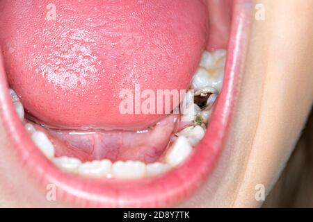 Frühe Karies und verfallene Zähne. Das Konzept der Pflege der Mundhöhle. Nahaufnahme der Innenseite des Mundes und Füllungen