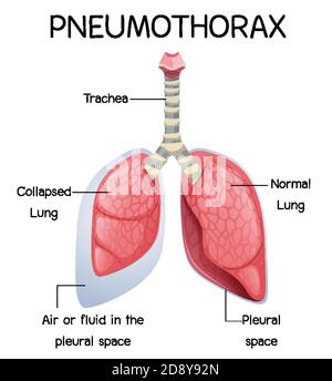 Pneumothorax Karikatur der menschlichen Anatomie Illustration Stock Vektor