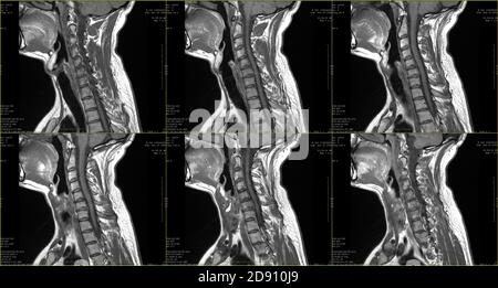 Satz von 6 sagittalen MRT-Aufnahmen des Halsbereichs von kaukasischer 34 Jahre alter Rüde mit beidseitiger paramedialer Extrusion Das C6-C7 Segment mit Radikulopathie Stockfoto